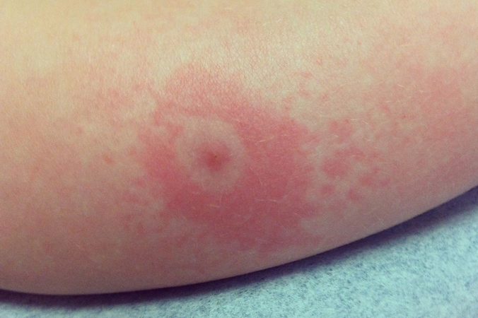 The classic sign of Lyme disease is the presence of an erythema migrans (EM) or “bulls-eye” rash
